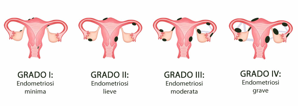 Endometriosi